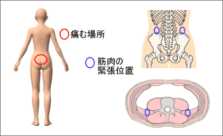 腰痛を治す腰痛アカデミーは腰痛やヘルニア、狭窄症、坐骨神経痛を治すため坂戸孝志先生により考案された自分で治せる治療法