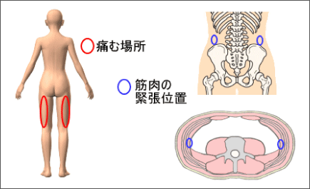 腰痛は腰痛アカデミーで、ヘルニア、狭窄症も治る、更に坐骨神経痛も治す坂戸孝志の名医による腰痛は自分で治せる治療法