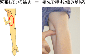 腰痛は腰痛アカデミーでわかる、腰痛、ヘルニア、狭窄症、坐骨神経痛、の緊張している筋肉=指先で押すと痛みがある写真