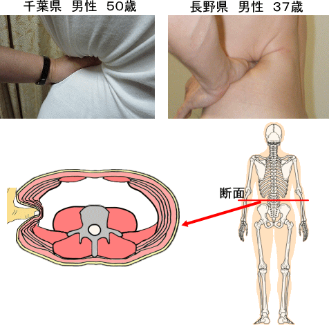 腰痛は腰痛アカデミーでわかる、腰痛、ヘルニア、狭窄症、坐骨神経痛、の柔らかい筋肉　千葉県男性50歳　長野県男性　37歳