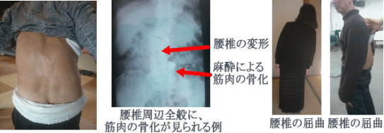 腰痛を腰痛アカデミーで痛みを消す、ヘルニア、狭窄症、坐骨神経痛等の痛みを改善させるための名医坂戸孝志のサポートを受けられた方腰椎の変形・増井による筋肉の骨化・腰椎周辺全般に筋肉の骨化が見られる例　腰椎屈曲の方①　腰椎の屈曲の方②。